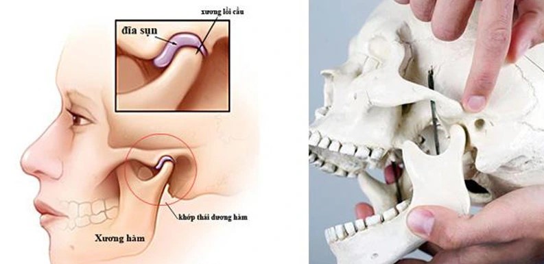 Dinh dưỡng hỗ trợ phòng ngừa biến chứng của viêm khớp thái dương hàm- Ảnh 1.