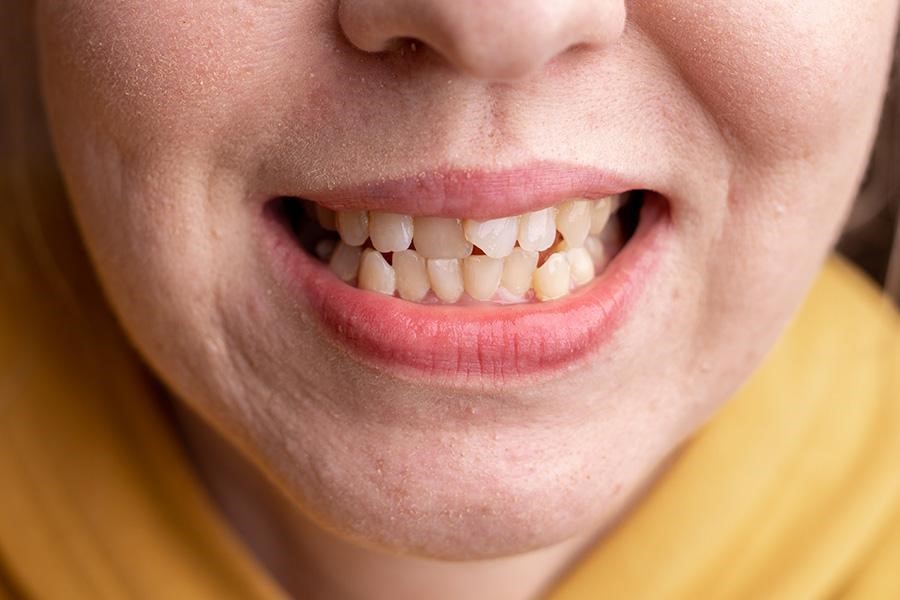 30 tuổi còn niềng răng được không? Phương pháp nào phù hợp?- Ảnh 1.