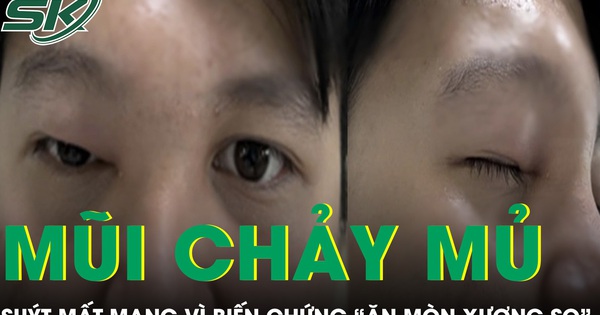 Mũi chảy mủ 4 ngày, nam thanh niên 20 tuổi suýt mất mạng