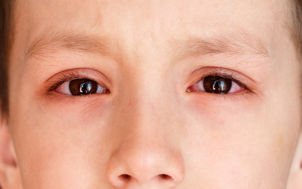 Viêm kết mạc ở trẻ em phòng và phát hiện như thế nào?