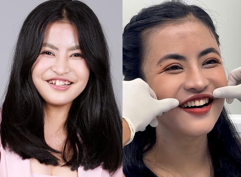 300 giờ phẫu thuật, 120 ngày thay đổi diện mạo: Vì sao chỉnh hàm chưa phải 'điểm kết'?- Ảnh 3.