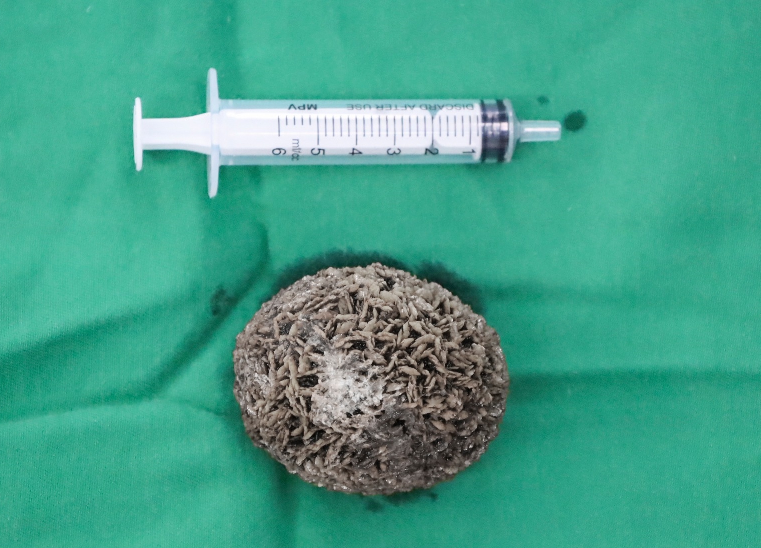 Phẫu thuật lấy viên sỏi bàng quang 'khủng' bằng quả trứng ngỗng- Ảnh 3.