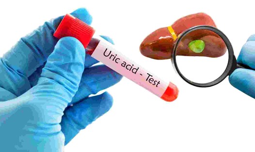 Cách dùng cần tây hỗ trợ giảm axit uric tại nhà: Lợi ích và những điều cần lưu ý- Ảnh 1.