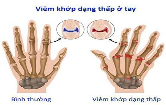 Dùng thuốc điều trị viêm khớp dạng thấp: Những điều người bệnh cần biết- Ảnh 1.