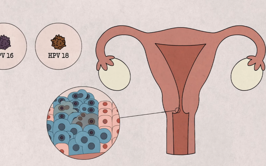 5 nhóm phụ nữ nên chú ý khám sàng lọc ung thư cổ tử cung