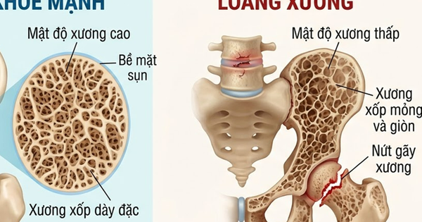 Phòng loãng xương cần hạn chế 5 loại thực phẩm này