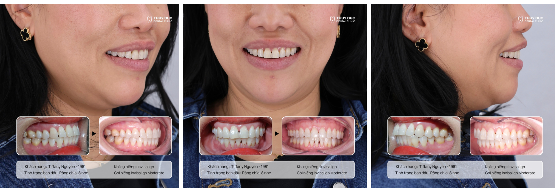 Vì sao người trưởng thành ngày càng chuộng niềng răng trong suốt Invisalign?- Ảnh 1. Vì sao người trưởng thành ngày càng chuộng niềng răng trong suốt Invisalign?- Ảnh 1.