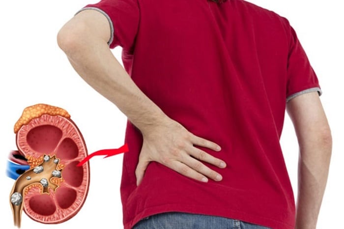 Sỏi thận có gây rối loạn cương dương?- Ảnh 1. Sỏi thận có gây rối loạn cương dương?- Ảnh 1.