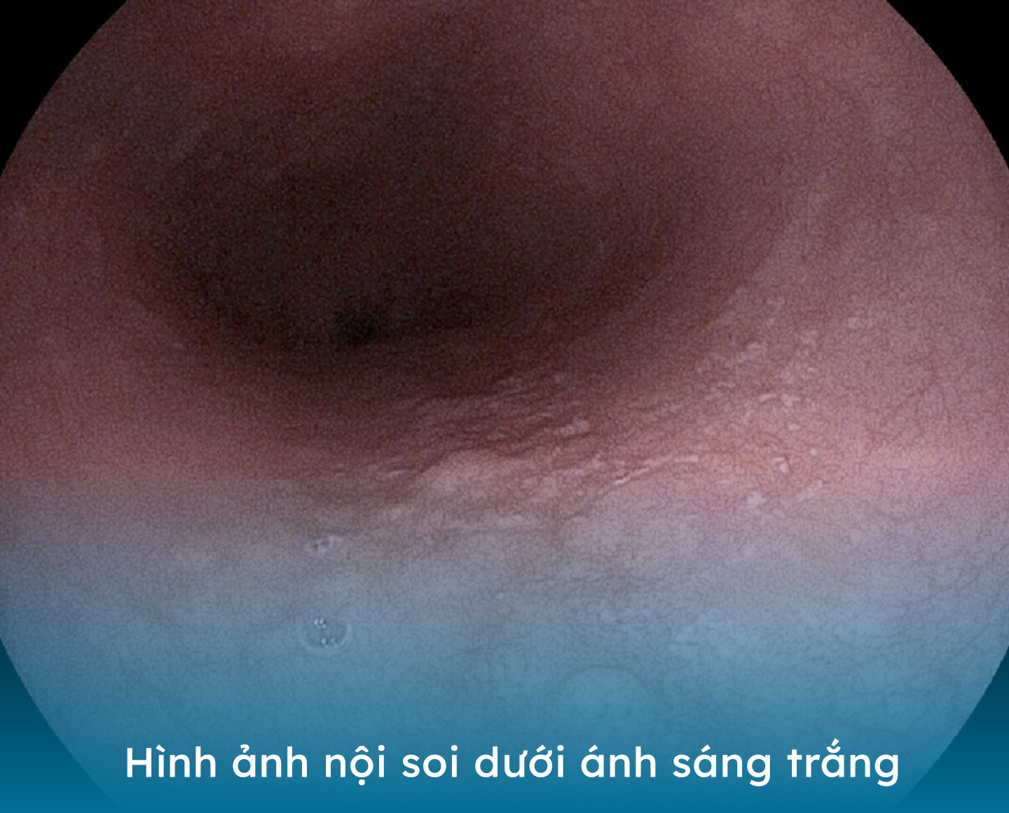 Bệnh viện Hoàn Mỹ Vinh: phát hiện nhiều trường hợp tiền ung thư thông qua nội soi- Ảnh 1. Bệnh viện Hoàn Mỹ Vinh: phát hiện nhiều trường hợp tiền ung thư thông qua nội soi- Ảnh 1.