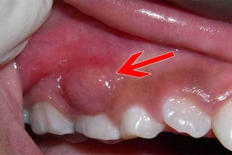 Cảnh báo biến chứng nguy hiểm của áp xe răng- Ảnh 1. Cảnh báo biến chứng nguy hiểm của áp xe răng- Ảnh 1.