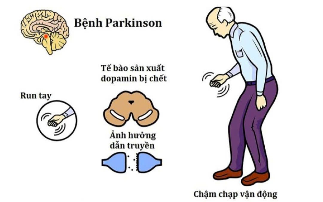 Cách làm chậm tiến triển bệnh Parkinson không dùng thuốc- Ảnh 2. Uống cà phê có tốt cho người mắc bệnh Parkinson không?