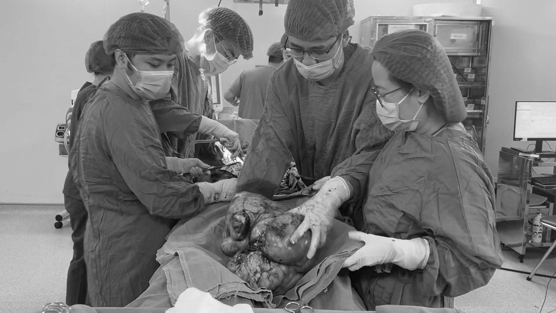 Người phụ nữ chịu đau âm ỉ vùng bụng suốt 6 tháng, đến viện, bác sĩ 'lấy ra' khối u sarcoma tử cung gần 9kg- Ảnh 1. Người phụ nữ chịu đau âm ỉ vùng bụng suốt 6 tháng, đến viện, bác sĩ 'lấy ra' khối u sarcoma tử cung gần 9kg- Ảnh 1.