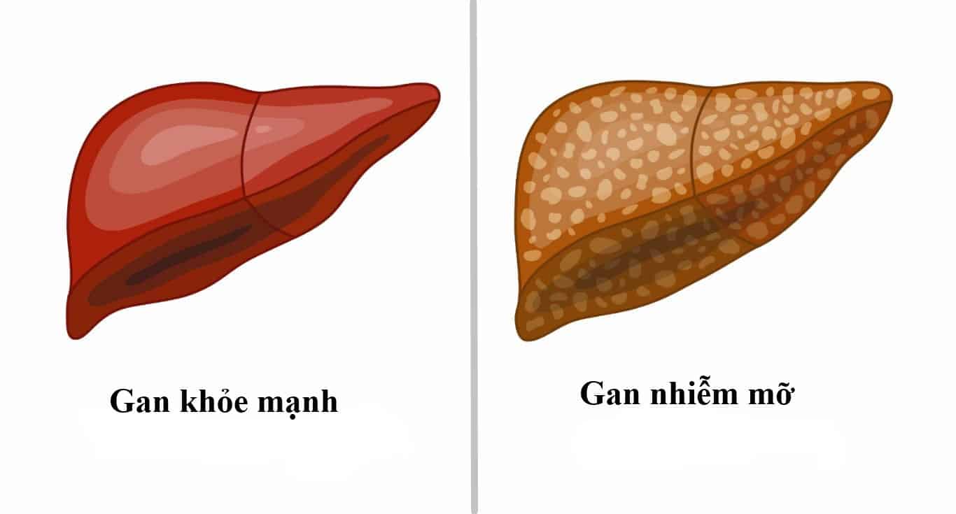 Không uống rượu bia, vì sao vẫn bị gan nhiễm mỡ?- Ảnh 2. Không uống rượu bia, vì sao vẫn bị gan nhiễm mỡ?- Ảnh 2.