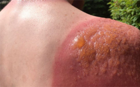 Phơi nắng bao lâu để đủ vitamin D mà không hại da?- Ảnh 2. Cách phòng ngừa nhạy cảm với ánh nắng mặt trời khi dùng thuốc kháng sinh