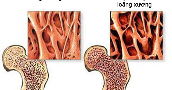 5 giải pháp đơn giản giúp duy trì xương chắc khỏe sau tuổi 50