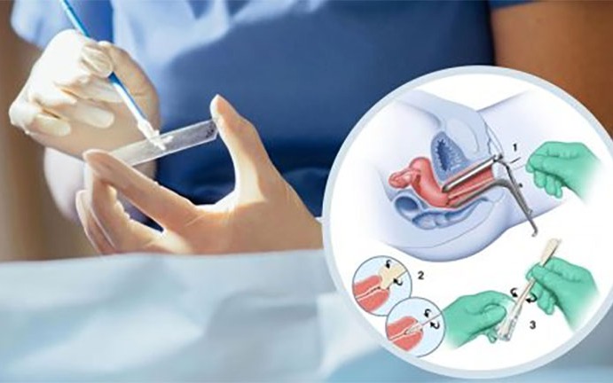 Quan hệ tình dục sớm và nguy cơ ung thư cổ tử cung- Ảnh 2. Cách tốt nhất để phát hiện sớm ung thư cổ tử cung