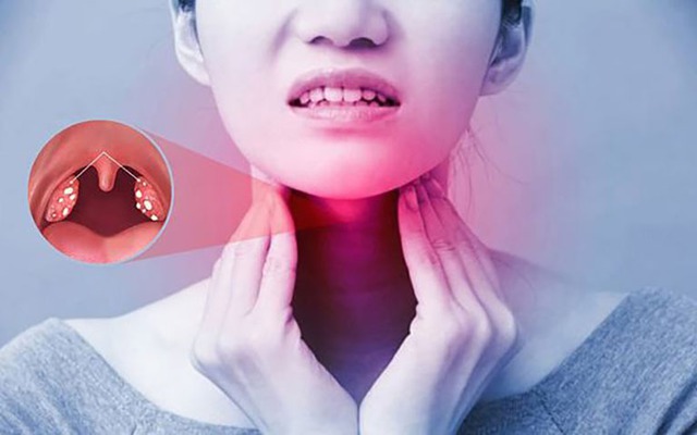 Tại sao viêm họng hạt dễ tái phát?- Ảnh 1.