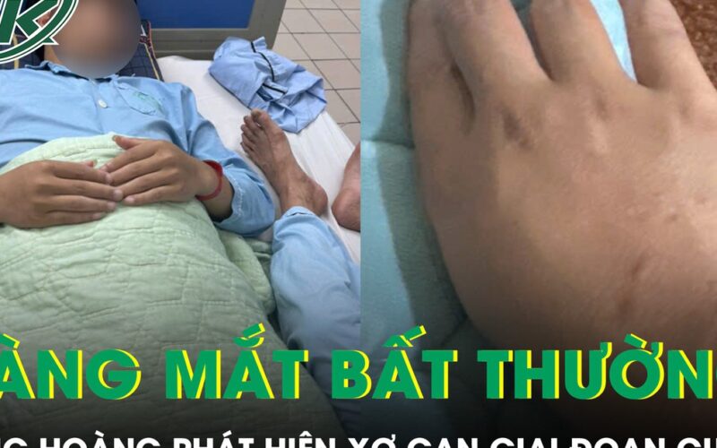 Da và mắt vàng bất thường, chàng trai 21 tuổi bàng hoàng phát hiện xơ gan giai đoạn cuối