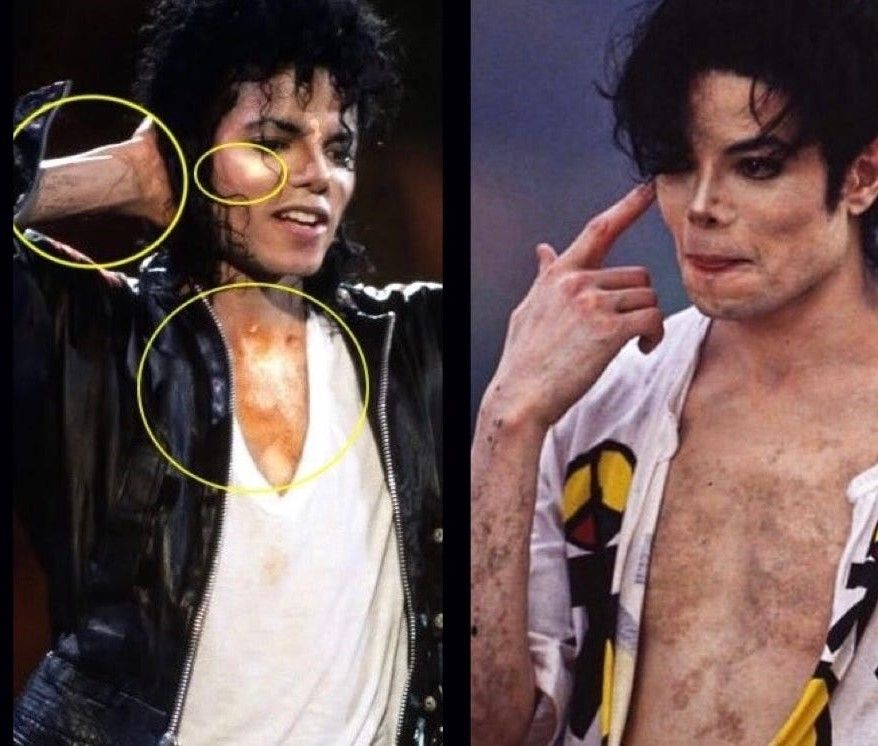 Sự thật về căn bệnh hiếm khiến Michael Jackson phải tẩy trắng da- Ảnh 2. Sự thật về căn bệnh hiếm khiến Michael Jackson phải tẩy trắng da- Ảnh 2.