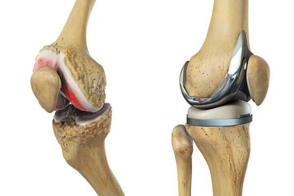 Thay khớp gối nhân tạo là một giải pháp hiệu quả cho những trường hợp tổn thương khớp nặng, giúp cải thiện đáng kể chất lượng cuộc sống. Thay khớp gối nhân tạo là một giải pháp hiệu quả cho những trường hợp tổn thương khớp nặng, giúp cải thiện đáng kể chất lượng cuộc sống.
