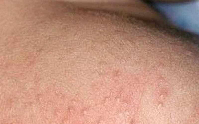 Mùa hè nhiều rôm sảy cần xử trí ra sao?