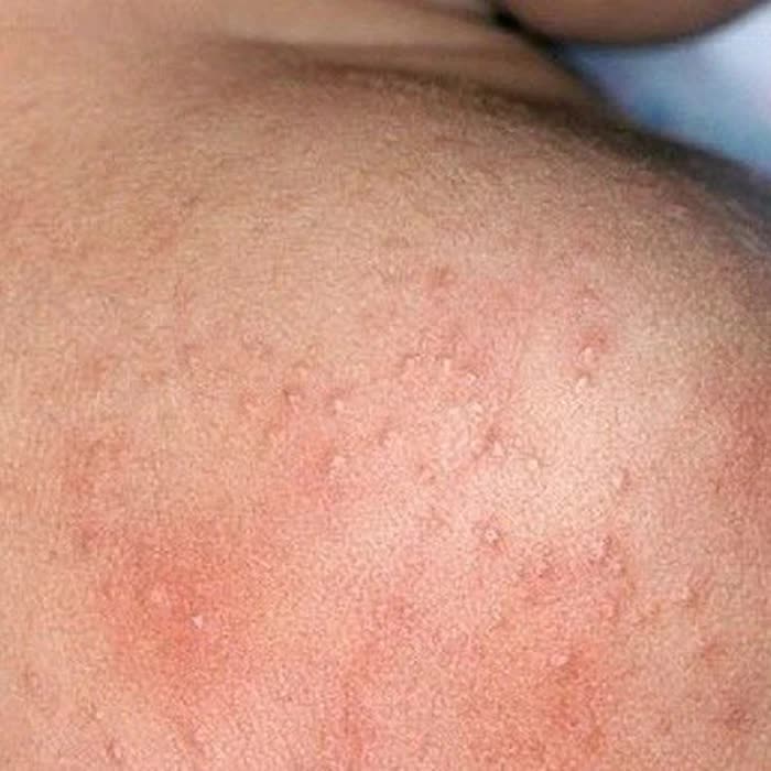 Mùa hè nhiều rôm sảy cần xử trí ra sao?- Ảnh 1.