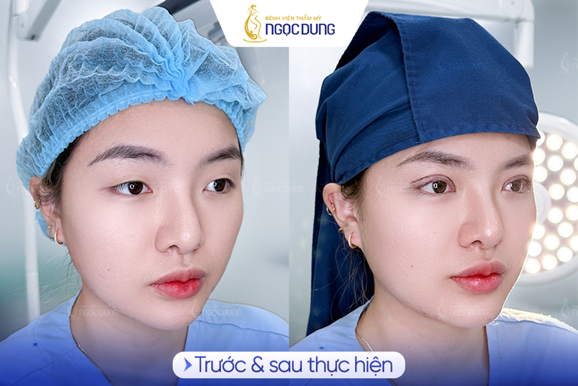 Có nên cắt mí mắt? Phân tích từ chuyên gia- Ảnh 3.