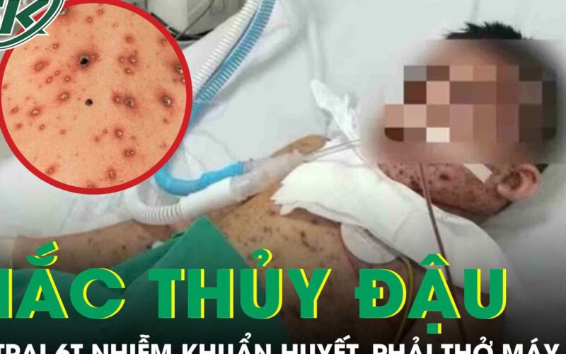 Biến chứng thủy đậu, bé trai 6 tuổi nhiễm khuẩn huyết, phải thở máy nguy kịch