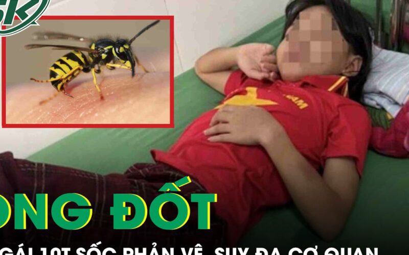 Ong vò vẽ đốt 70 vết, bé gái 10 tuổi sốc phản vệ, suy đa cơ quan phải cấp cứu gấp
