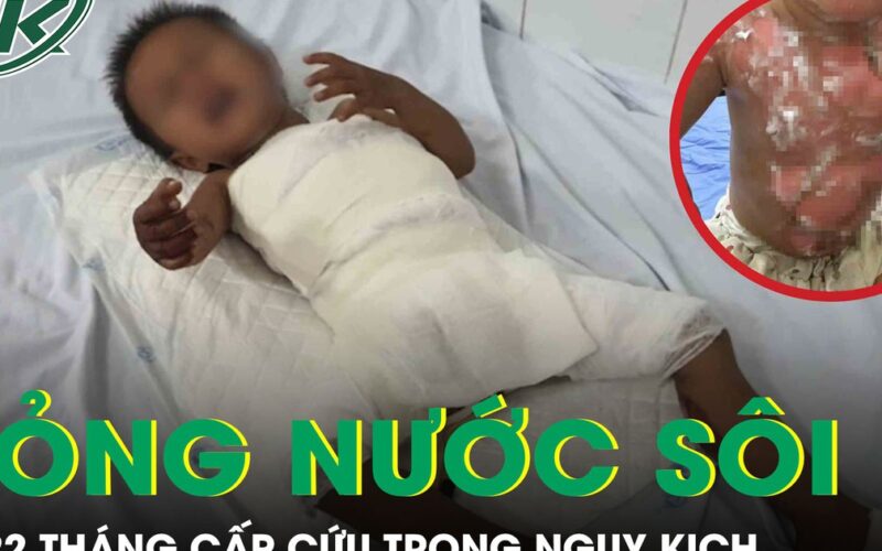 Bé 22 tháng tuổi bỏng nước sôi cấp cứu trong nguy kịch