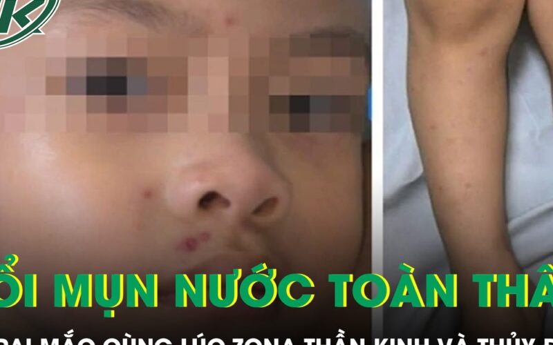Bé trai 4 tuổi nổi kín mụn nước toàn thân sau khi mắc cùng lúc zona thần kinh và thủy đậu