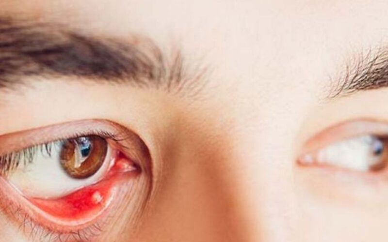 Nguyên nhân gây cộm mắt và cách khắc phục