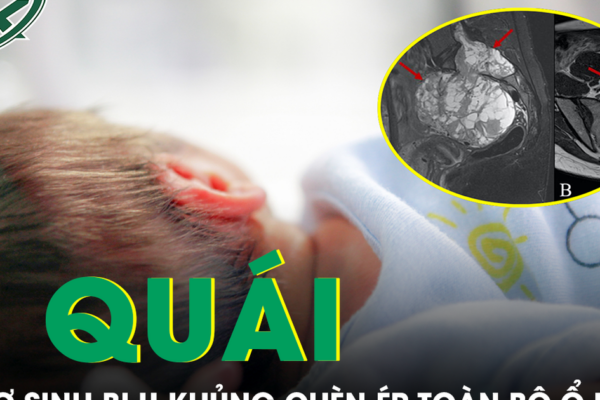 Cứu trẻ sơ sinh 10 ngày tuổi mang khối u hiếm gặp, chèn ép toàn bộ ổ bụng