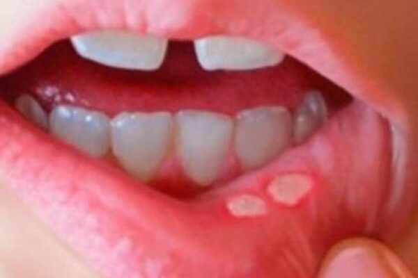Phân biệt nhiệt miệng và ung thư lưỡi: Cách nhận biết sớm căn bệnh nguy hiểm