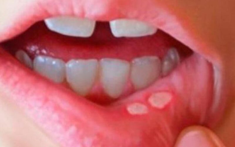 Phân biệt nhiệt miệng và ung thư lưỡi: Cách nhận biết sớm căn bệnh nguy hiểm