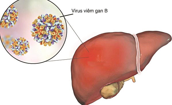 photo-1780123810128-1780123811682621133488 Viêm gan B là gì? Tổng quan về viêm gan B