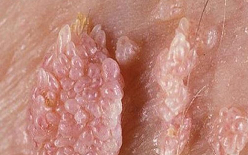 Dấu hiệu nhận biết sớm bệnh sùi mào gà ở phụ nữ