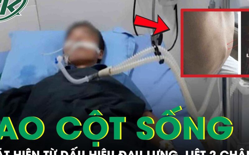 Đau lưng kéo dài nhưng chủ quan, người đàn ông bất ngờ liệt hai chân vì lao cột sống