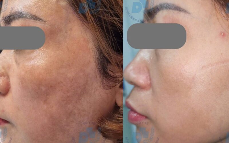 Bác sĩ chỉ rõ lý do nhiều người trị nám tốn kém nhưng vẫn tái phát