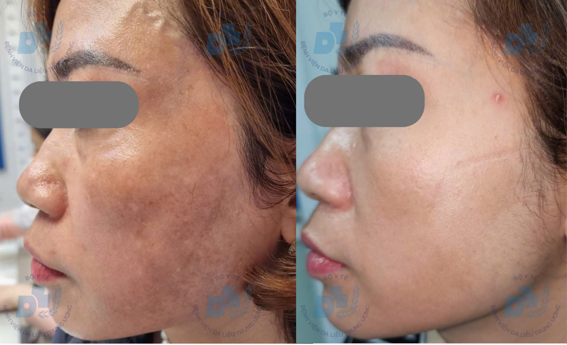 tri-nam-da-17794293905881209480586 Bác sĩ chỉ rõ lý do nhiều người trị nám tốn kém nhưng vẫn tái phát- Ảnh 2.