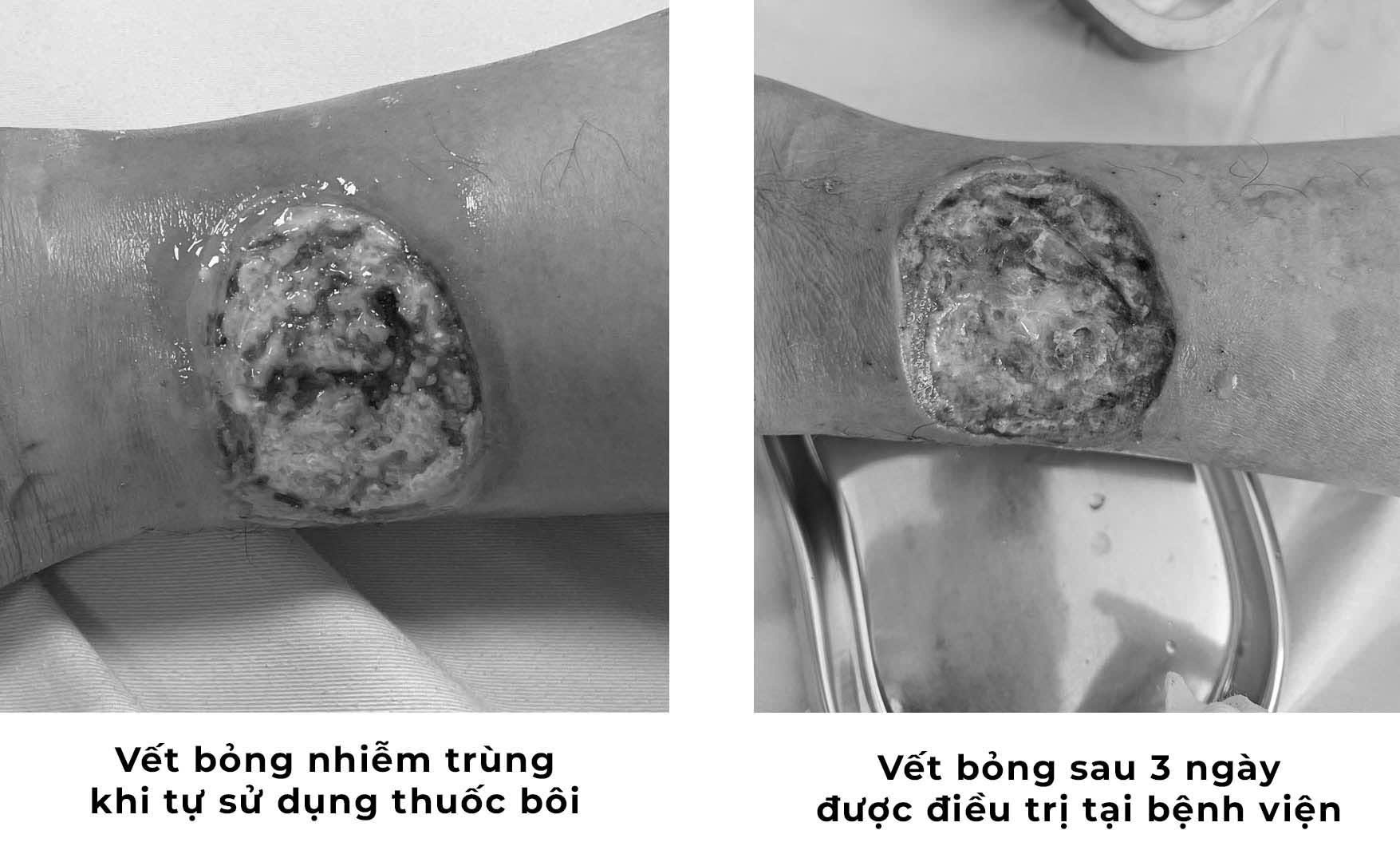vet-bong-nhiem-trung-nang-khi-tu-y-su-dung-thuoc-boi-dan-gian-1778147094613768305234 Tự chữa bỏng bằng thuốc dân gian, người đàn ông suýt hoại tử chân- Ảnh 1.