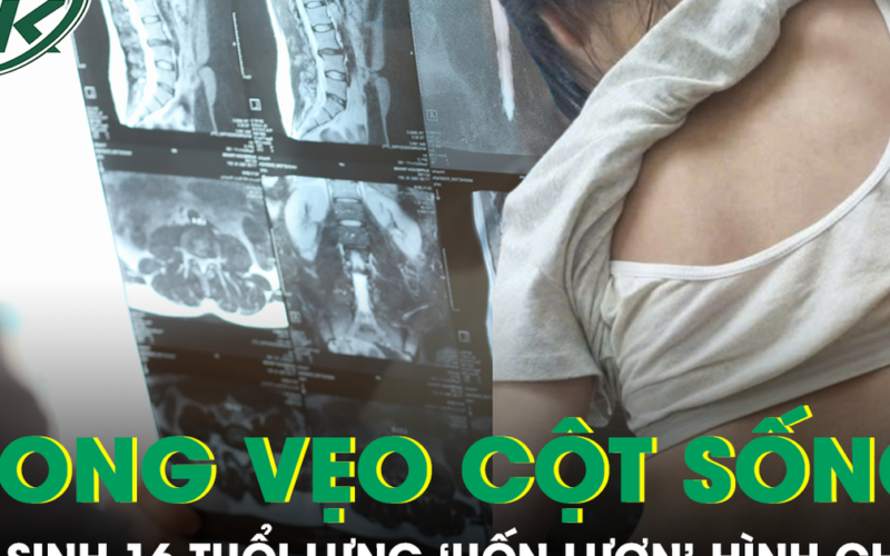 Tự ý ngừng đeo nẹp vì sợ bạn bè trêu chọc, nữ sinh 16 tuổi đối mặt nguy cơ mổ cột sống