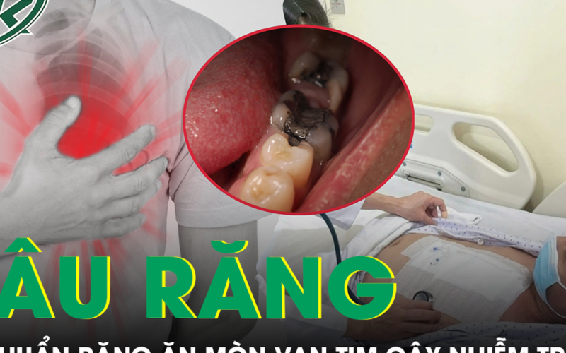 Hơn 10 chiếc răng sâu khiến người đàn ông 57 tuổi bị vi khuẩn ăn mòn van tim