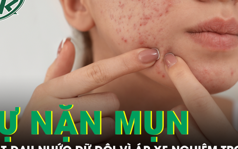 Tự nặn mụn quanh môi, cô gái nhập viện vì áp xe mặt, nhiễm vi khuẩn kháng thuốc