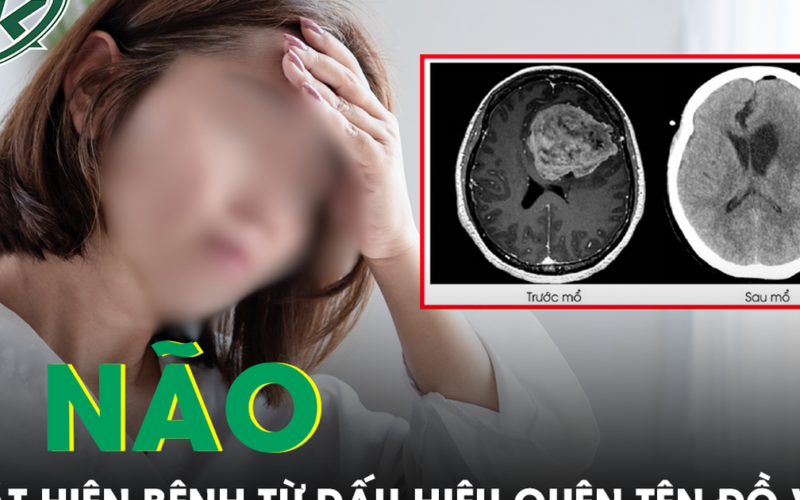 Liên tục quên tên đồ vật quen thuộc, người phụ nữ phát hiện khối u não nguy hiểm