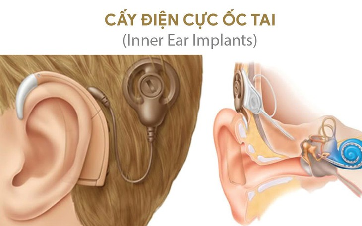 Nghe kém, nghẹt tai kéo dài do đâu?- Ảnh 1.
