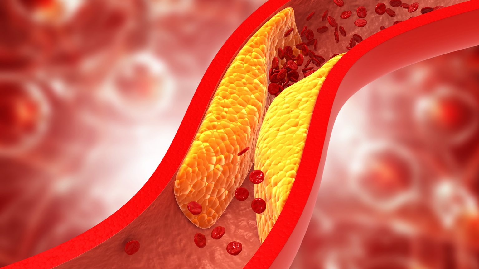 cholesterol-1-1740311342760666235916 Thay đổi lối sống giúp kiểm soát cholesterol cao, giảm nguy cơ bệnh tim mạch- Ảnh 2.