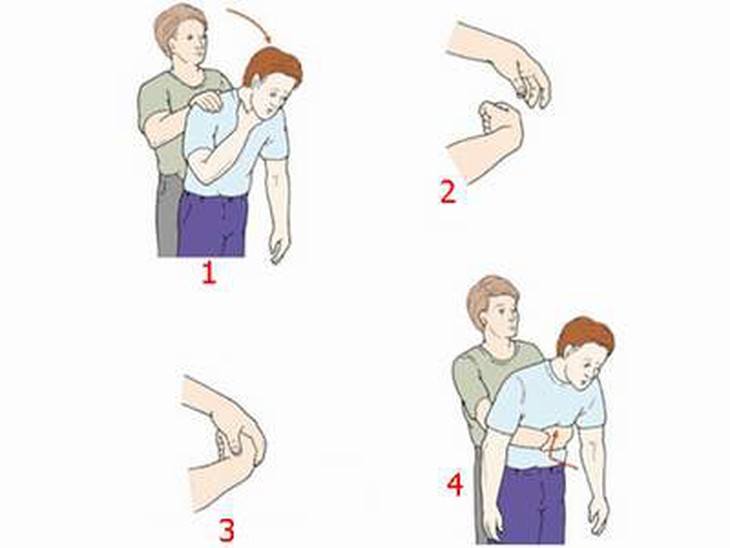Người đàn ông 56 tuổi hoảng loạn vì ong vò vẽ sống trong tai- Ảnh 2.