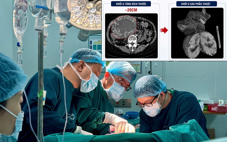Cứ nghĩ bị trĩ, người phụ nữ bất ngờ phát hiện khối polyp lớn trong trực tràng- Ảnh 1.