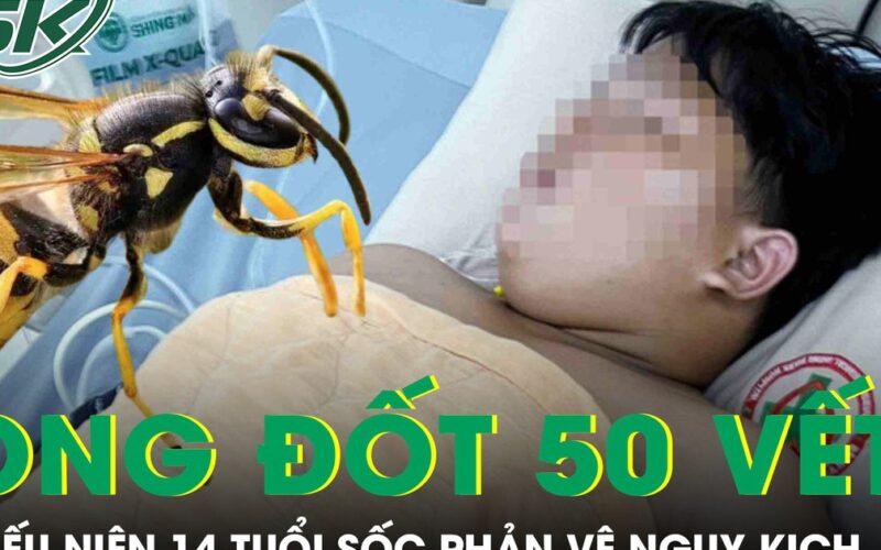 Bị ong vò vẽ đốt hơn 50 vết, thiếu niên 14 tuổi hoại tử, sốc phản vệ nguy kịch